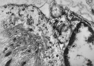 M,3m. | rhabdomyosarcoma in retented testis M,3m. | rhabdomyosarcoma in retented testis